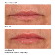 NassifMD Hydro - Screen For Lips 4ml