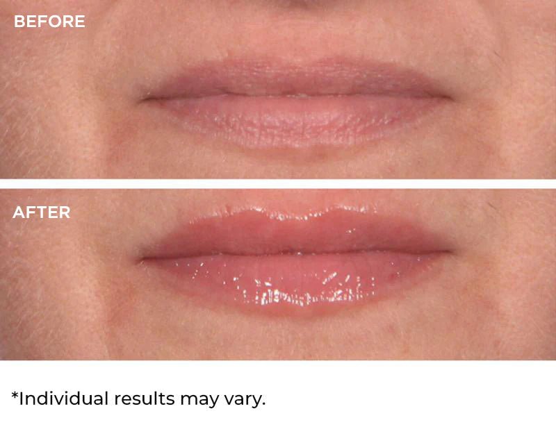 NassifMD Hydro - Screen For Lips 4ml